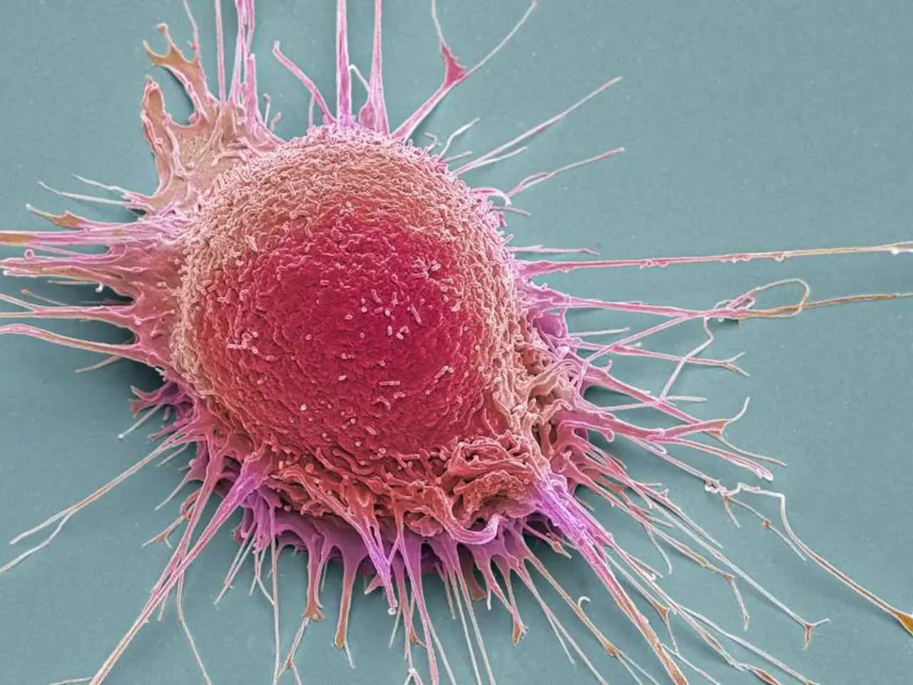 Cáncer: descubren cómo los tumores “asfixian” a las células T para escapar del sistema inmunitario