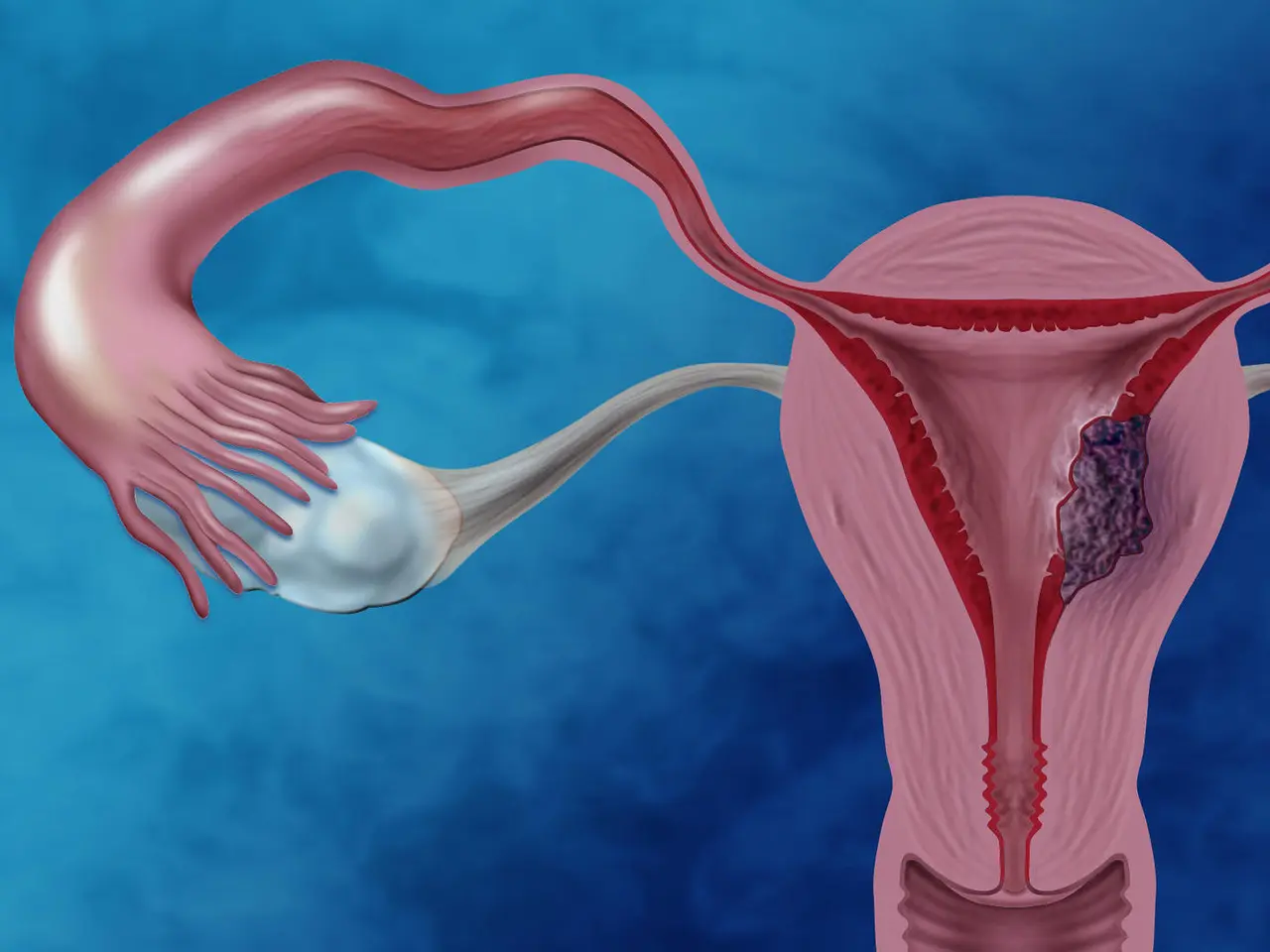 Ilustración médica del útero y las células tumorales para representar la investigación de un fármaco experimental contra el cáncer de endometrio avanzado o recurrente.
